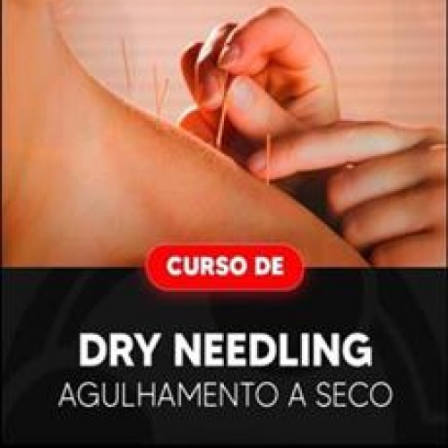 Dry Needling: Agulhamento a Seco - INAESP